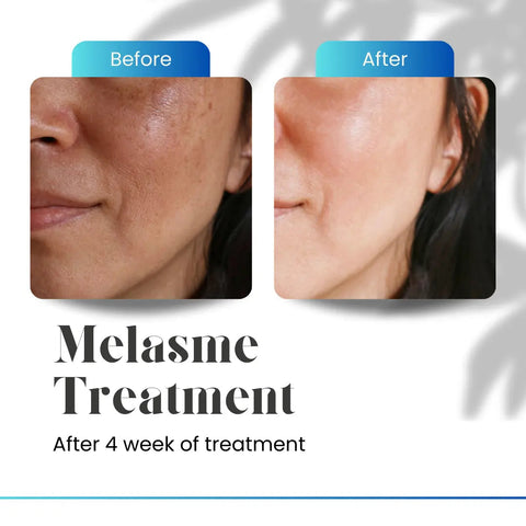 Hyperpigmentation Serum for Dark Spots Eraser and Radiant Skin - Cosmecell