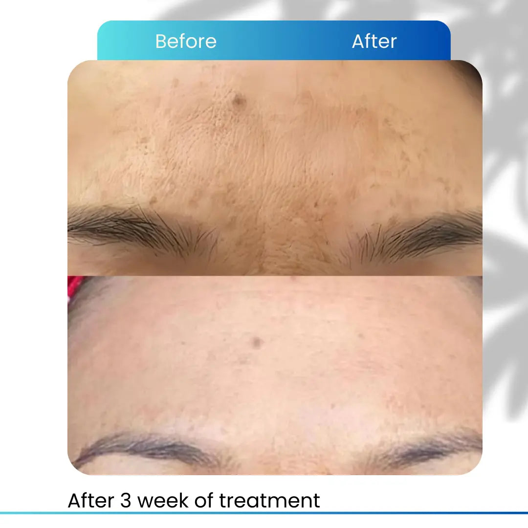 Hyperpigmentation Serum for Dark Spots Eraser and Radiant Skin - Cosmecell